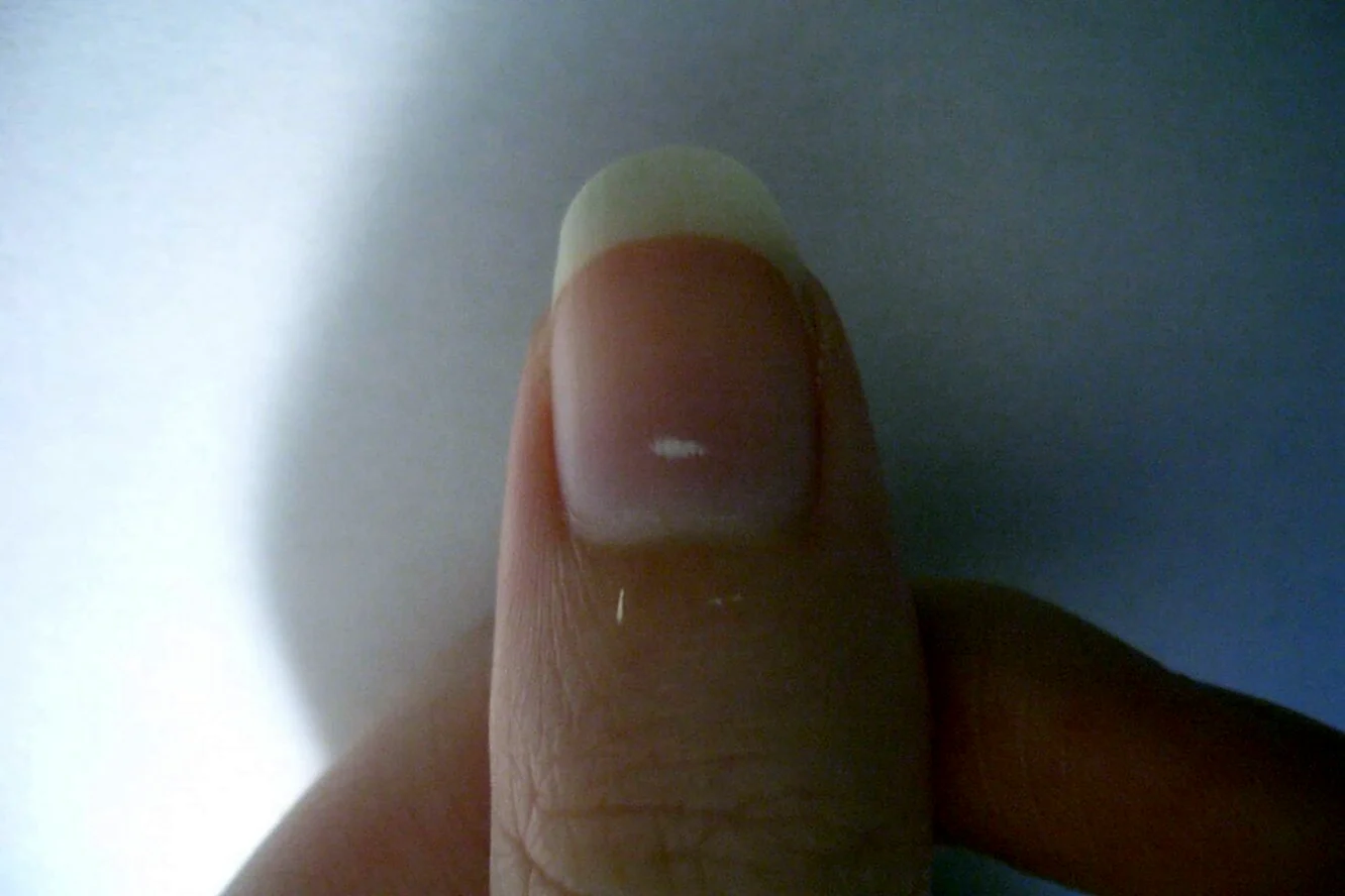Белое пятно на ногте большого пальца