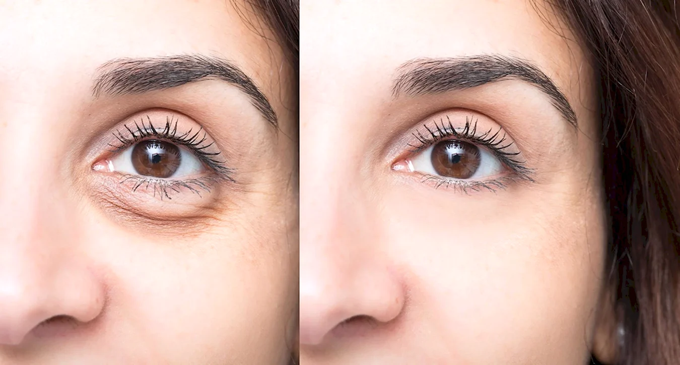 Dark circle under Eye Filler before and after