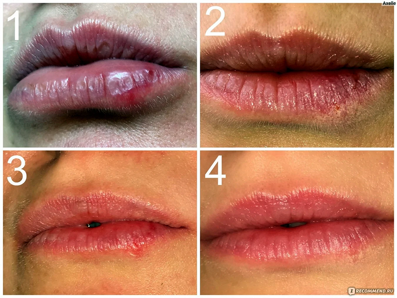 Этапы заживления перманентного макияжа губ