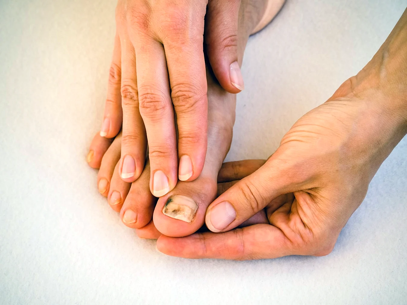 Грибок ногтей на пальцах ног