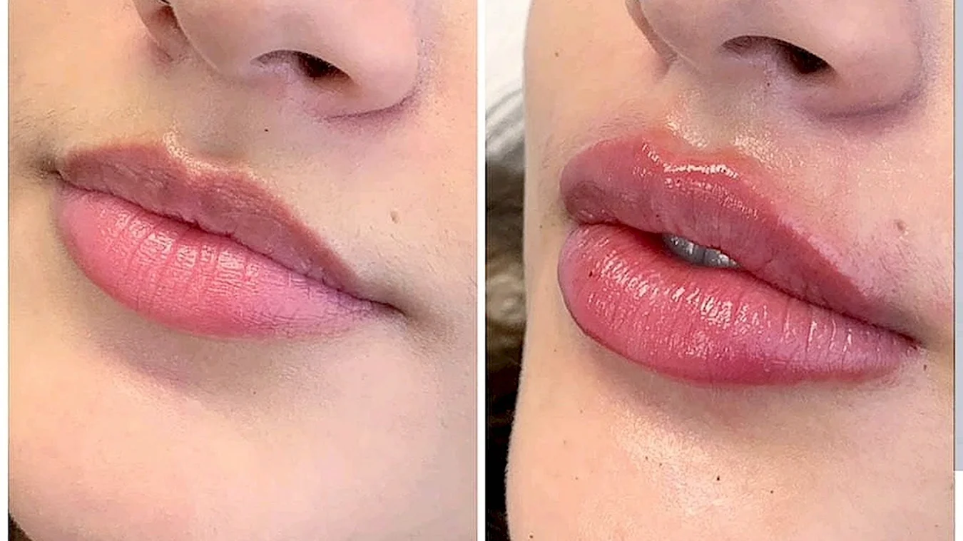 Красивые губы после увеличения