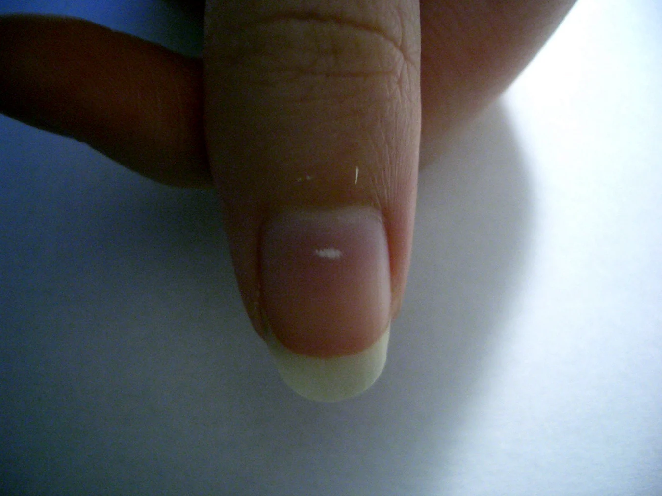 Лейконихия белые пятна на ногтях