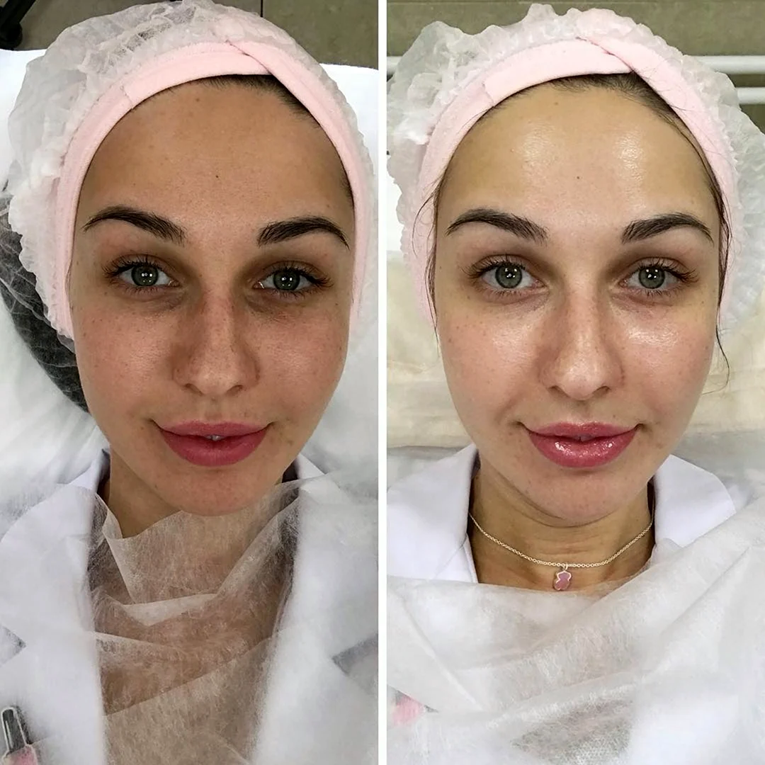 Лицо до и после косметолога