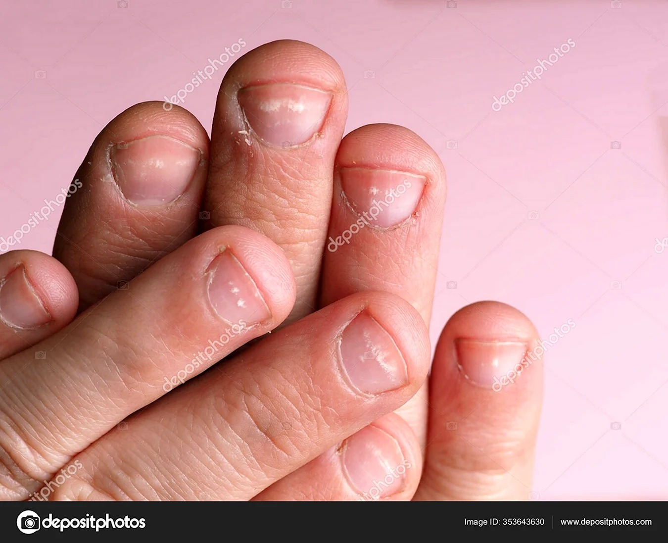 Маленькие ногти заболевание