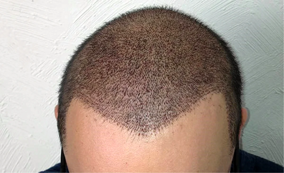 Месяц после пересадки волос