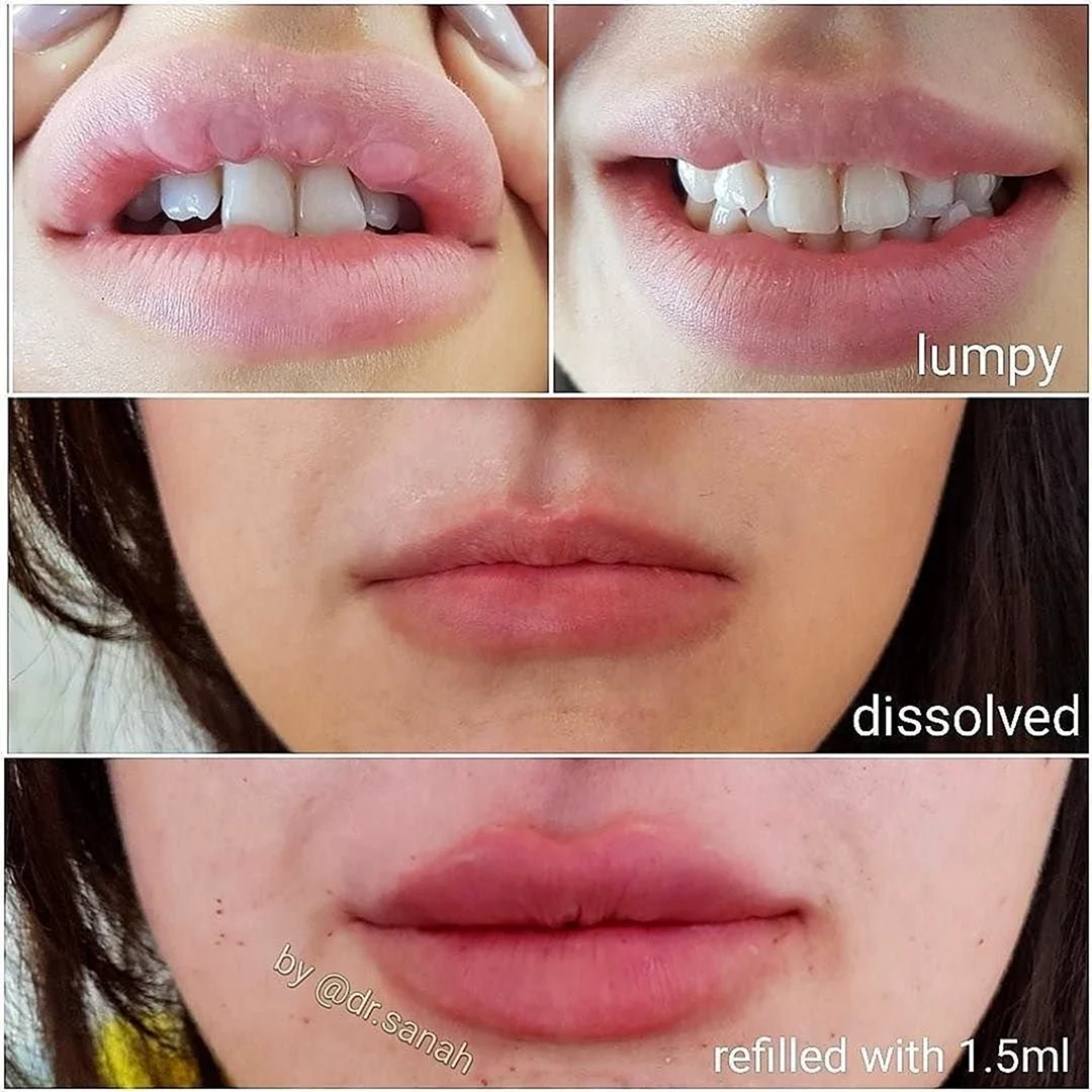 Методика введения филлера в губы