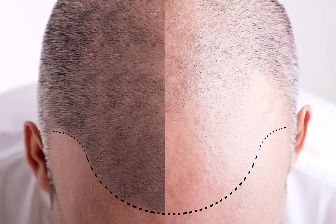 Микропигментация кожи головы