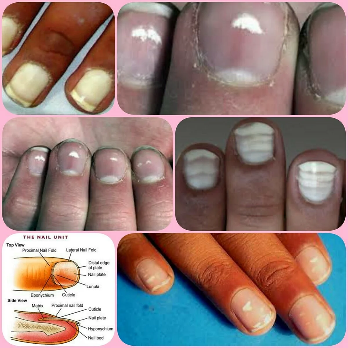 Негрибковые заболевания ногтей таблица