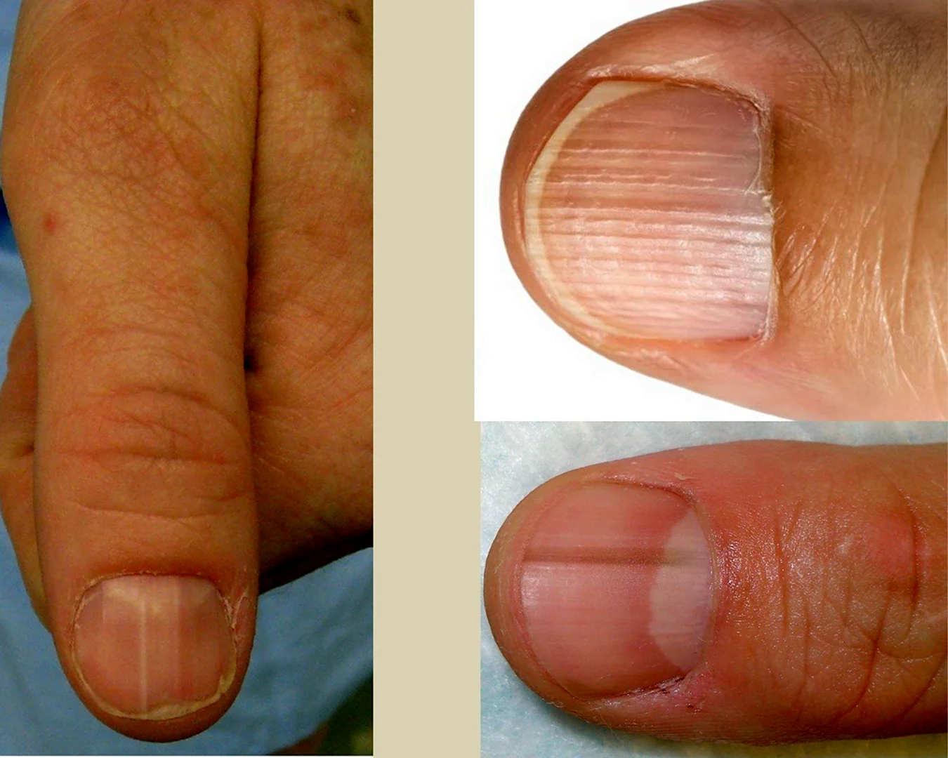 Неровности на ногтевой пластине
