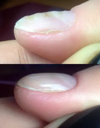 Неровности на ногтевой пластине