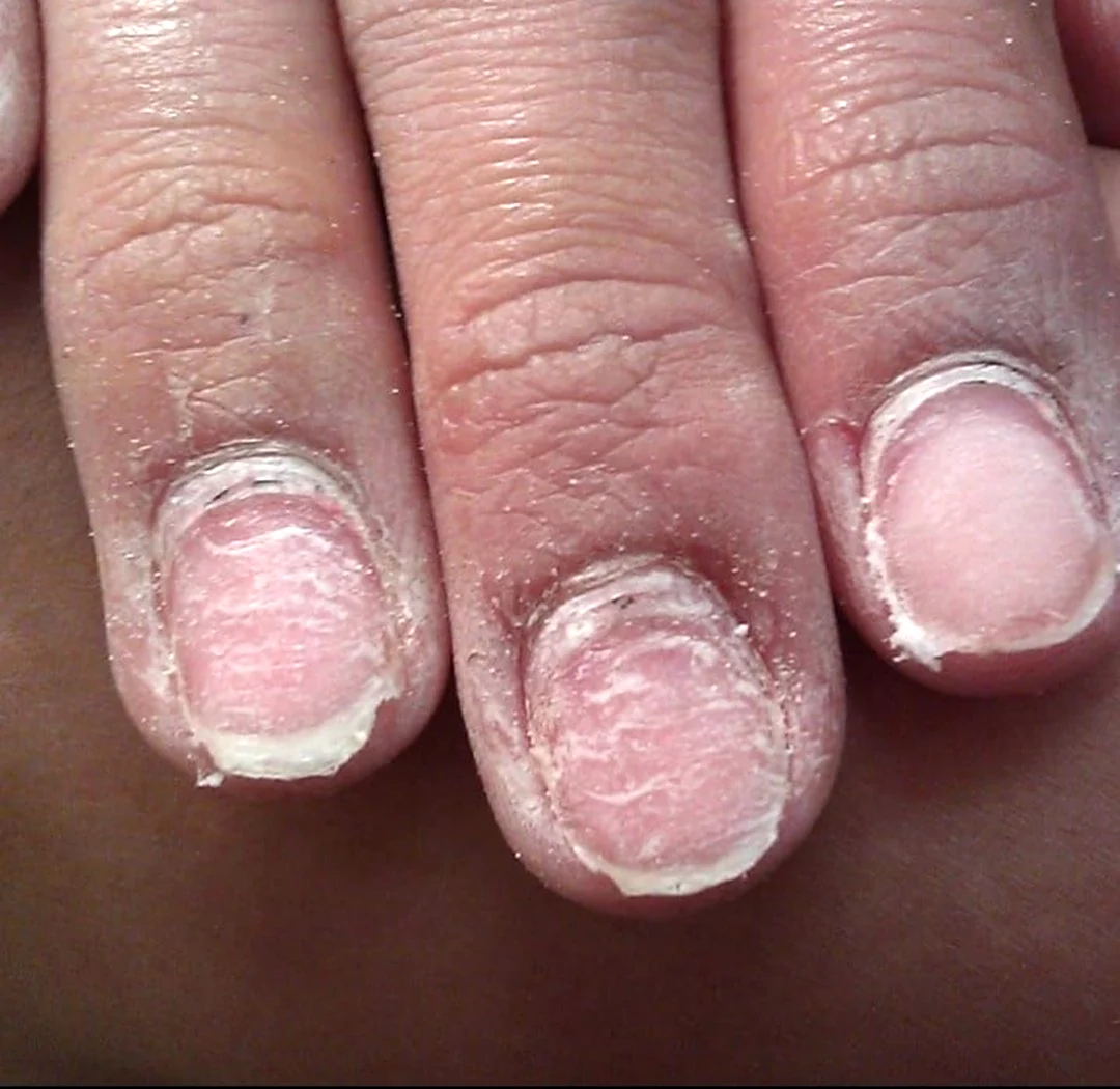 Ногти после снятия материала