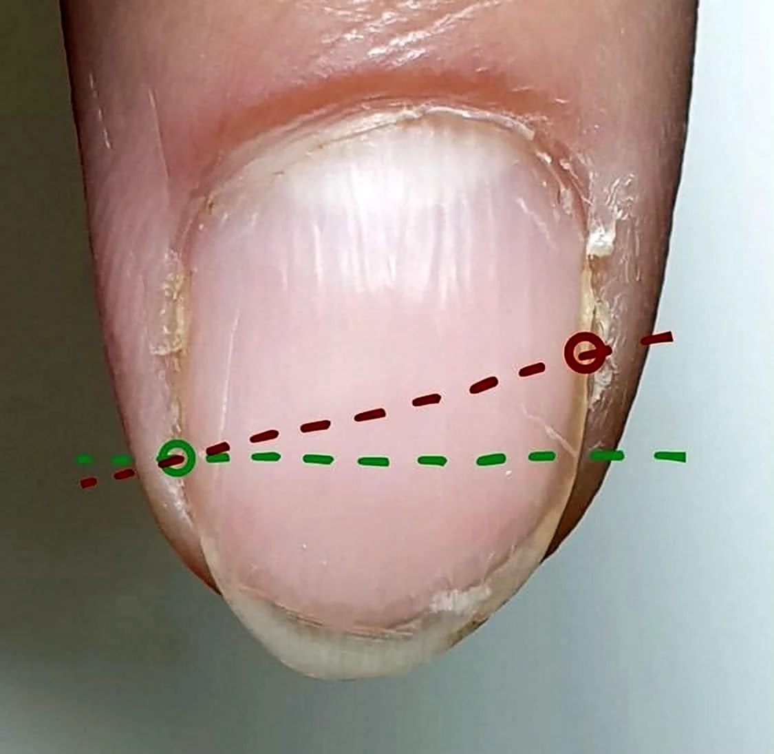 Онихолизис ногтей на точках роста