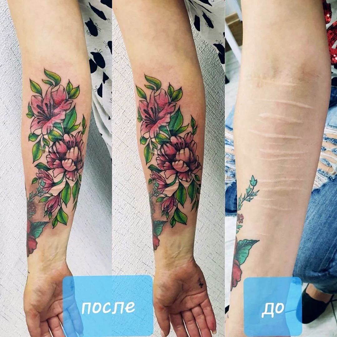 Перекрытие шрамов татуировкой