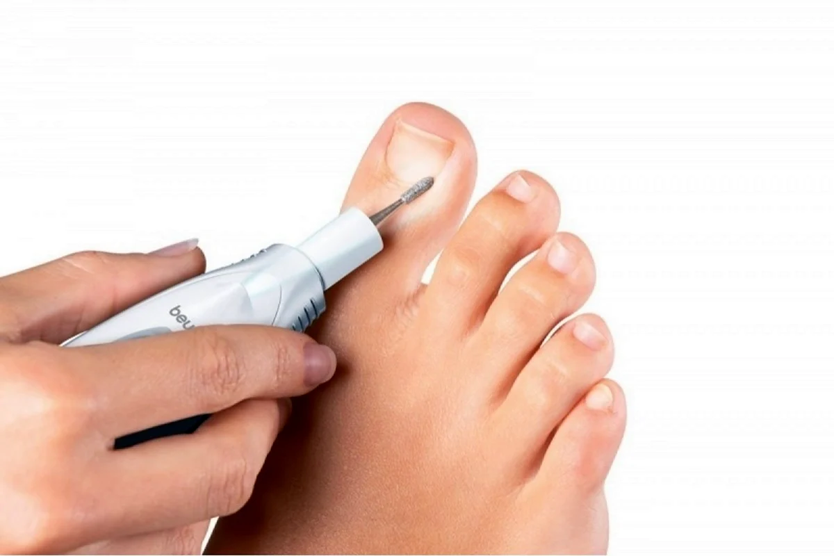 Пилить ногти на ногах дерматолог