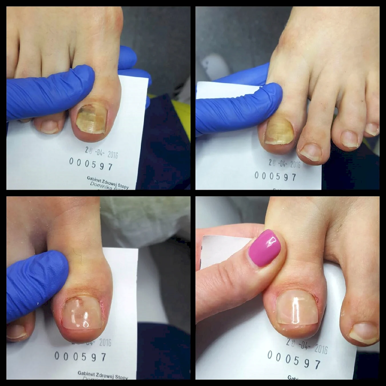 Протезирование ногтя на ногтя