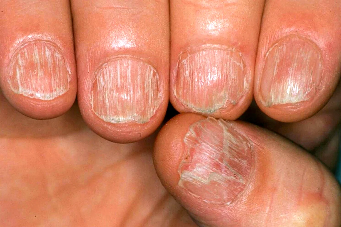 Срединная каналообразная дистрофия ногтей