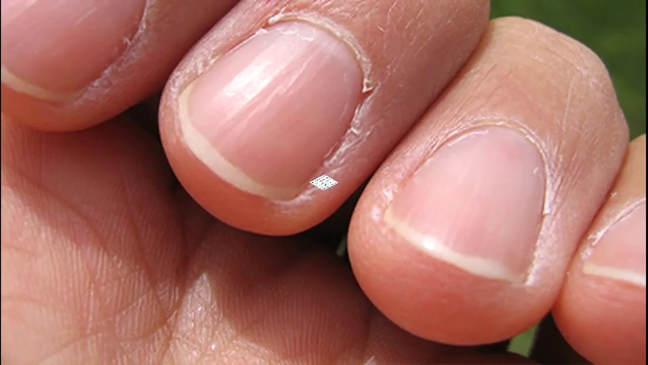 Трещина у основания ногтя на руке
