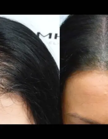 Трихопигментация волос у женщин