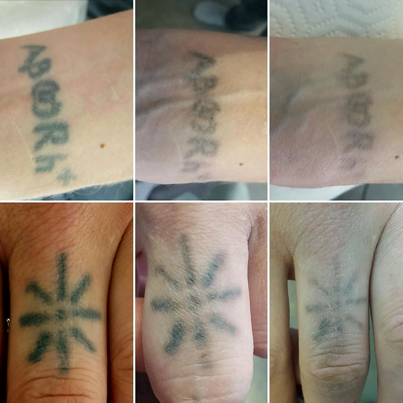 Удаление татуировок лазером до и после