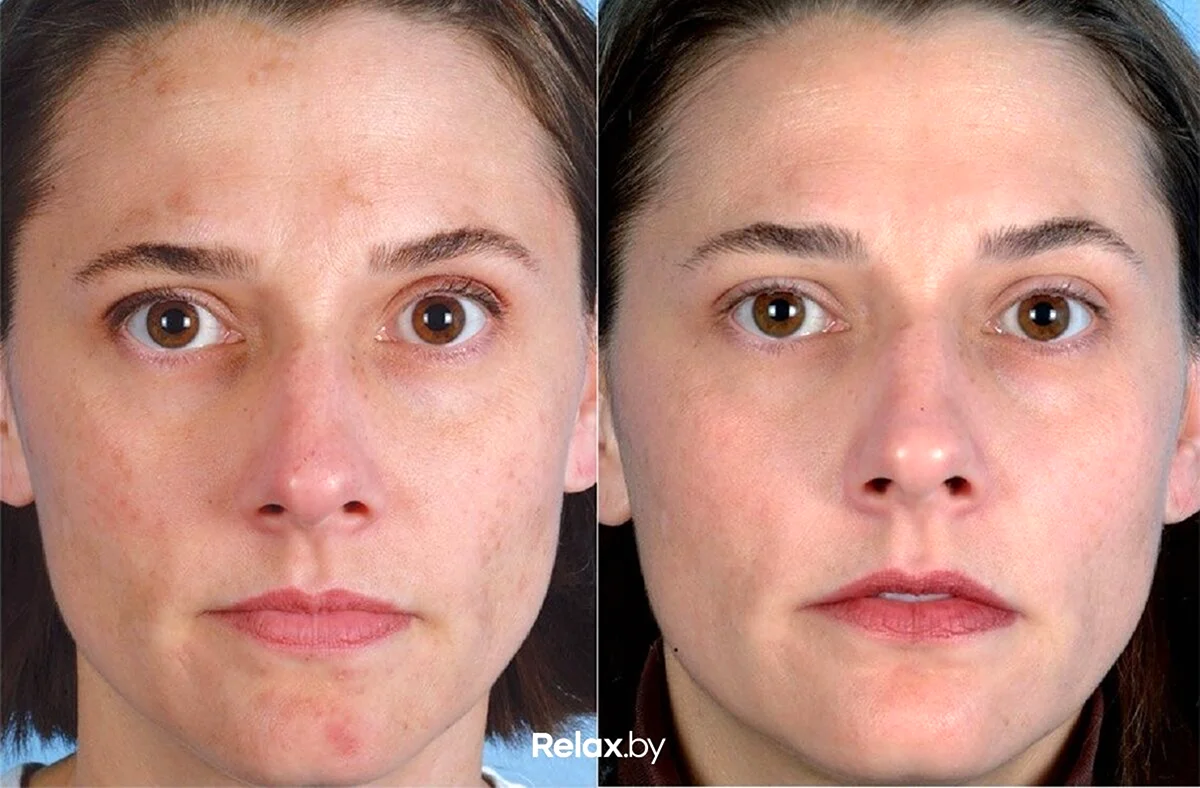 Ультразвуковая чистка лица до и после