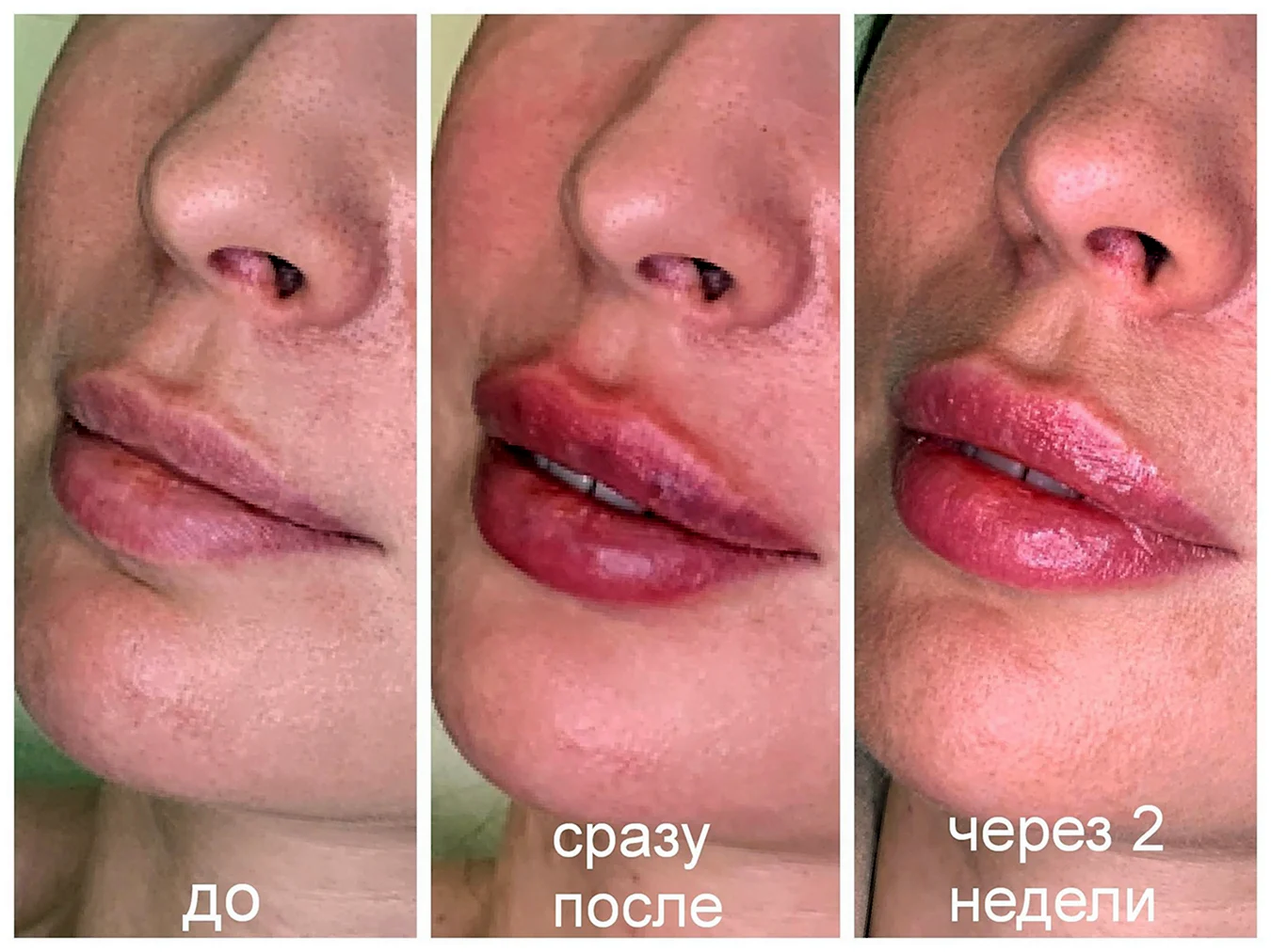 Увеличение губ до и после
