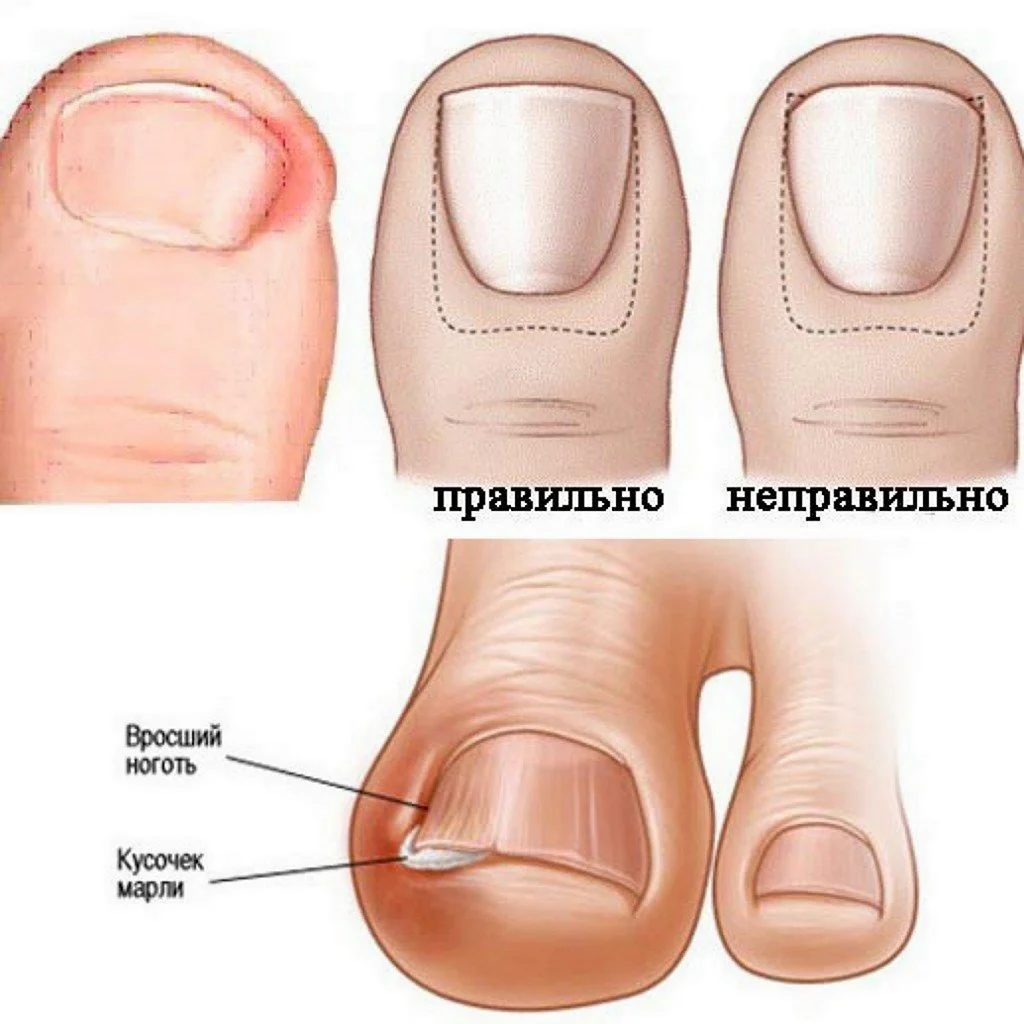 Врастание ногтя на большом пальце ноги