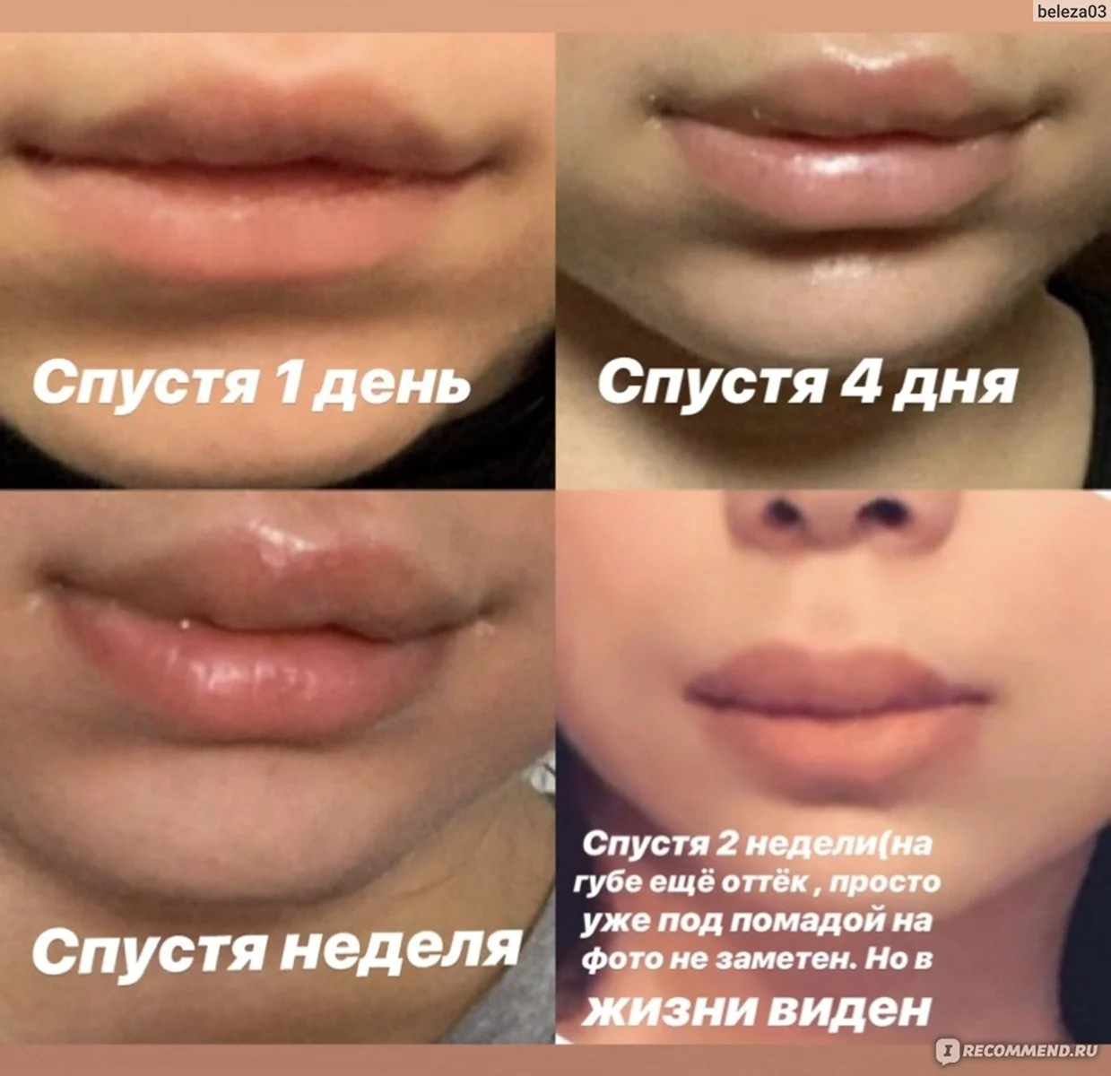 Введение гиалуроновой кислоты в губы