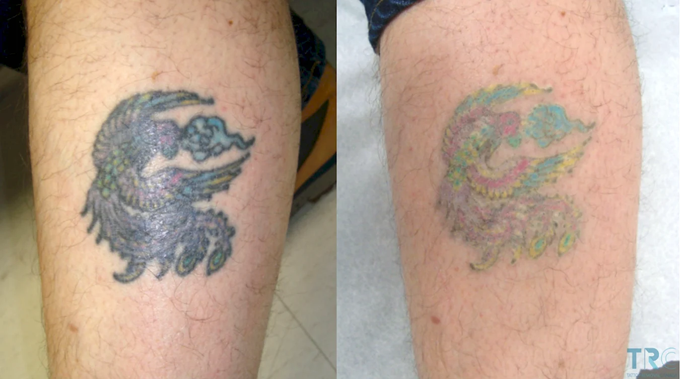 Выведение цветных татуировок лазером