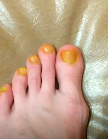 Жёлтые ногти на ногах грибок
